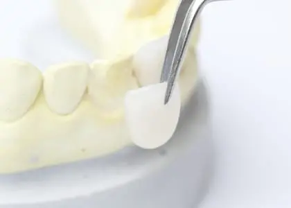 イメージ:ラミネートベニア
